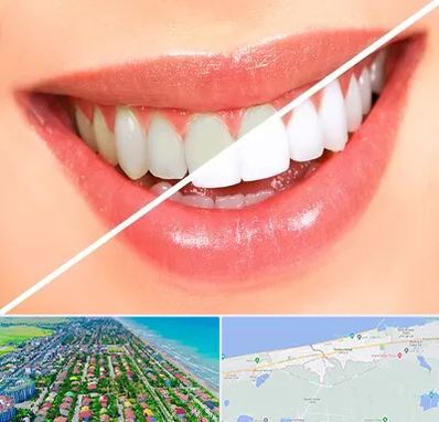 بلیچینگ دندان در فریدونکنار