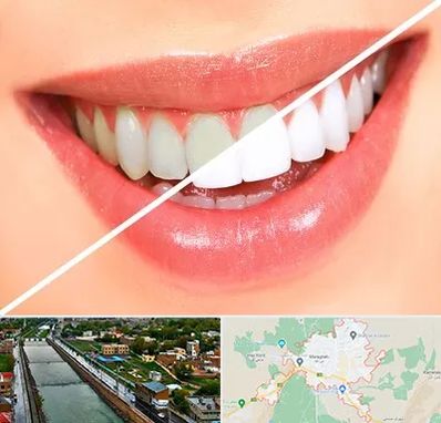 بلیچینگ دندان در مراغه