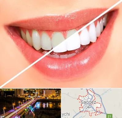 بلیچینگ دندان در سقز