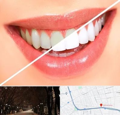 بلیچینگ دندان در ابوریحان تبریز