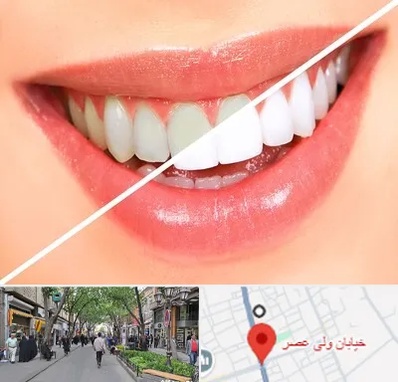 بلیچینگ دندان در ولیعصر شهریار
