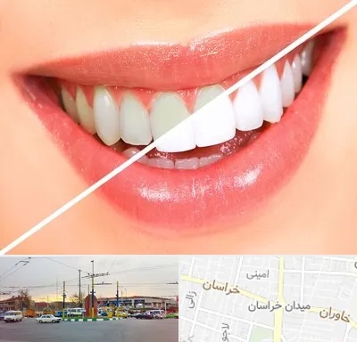 بلیچینگ دندان در میدان خراسان