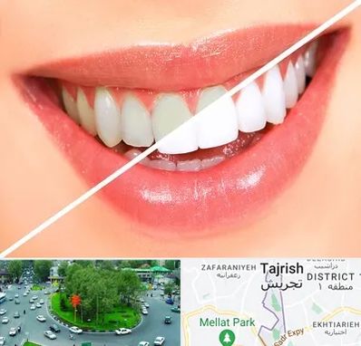 بلیچینگ دندان در تجریش 