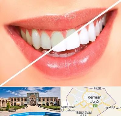 بلیچینگ دندان در کرمان