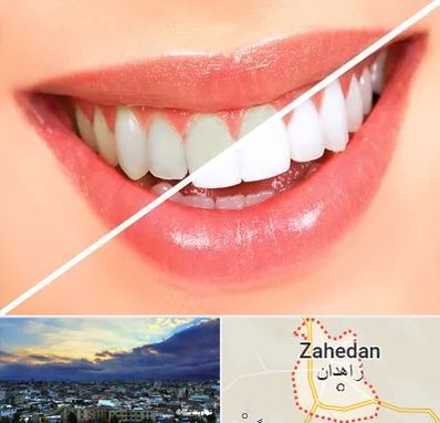 بلیچینگ دندان در زاهدان