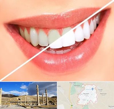 بلیچینگ دندان در مرودشت
