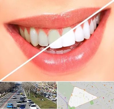 بلیچینگ دندان در احمدآباد مشهد