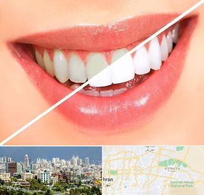 بلیچینگ دندان در شرق تهران 