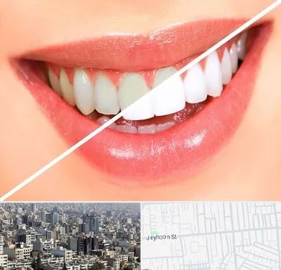 بلیچینگ دندان در جیحون