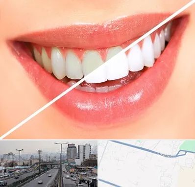 بلیچینگ دندان در بلوار ارتش