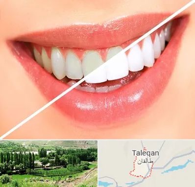 بلیچینگ دندان در طالقان