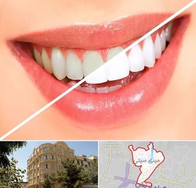 بلیچینگ دندان در مینی سیتی