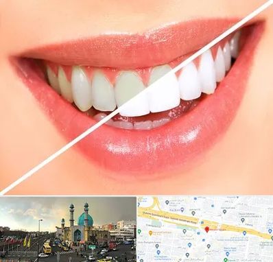 بلیچینگ دندان در رسالت