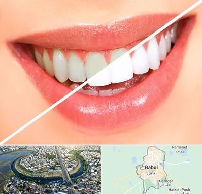 بلیچینگ دندان در بابل