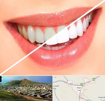 بلیچینگ دندان در بیجار