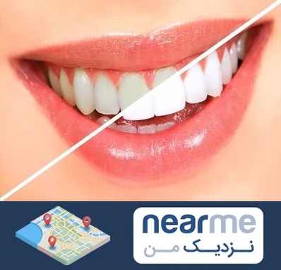 بلیچینگ دندان در نزدیک من