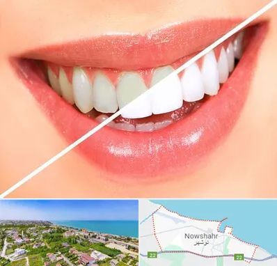 بلیچینگ دندان در نوشهر