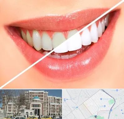 بلیچینگ دندان در طلاب مشهد