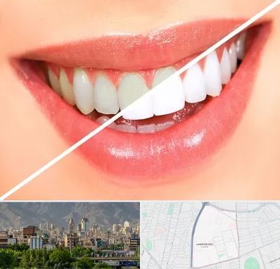 بلیچینگ دندان در جمشیدیه