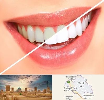 بلیچینگ دندان در یزد