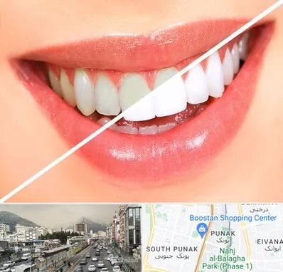 بلیچینگ دندان در پونک 