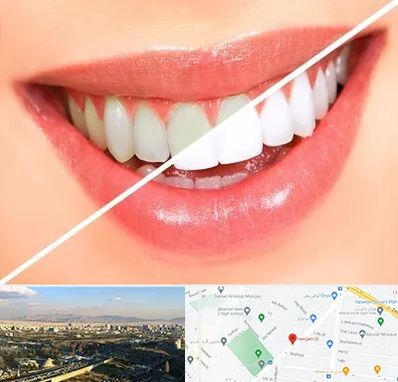 بلیچینگ دندان در هنگام