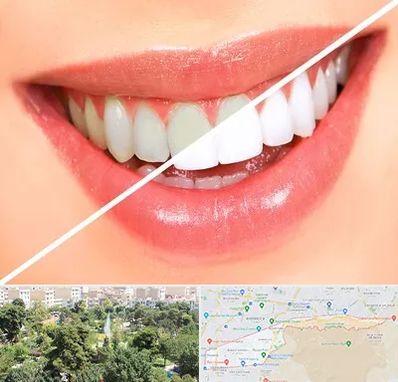 بلیچینگ دندان در منطقه 13 تهران