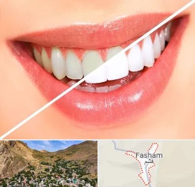 بلیچینگ دندان در فشم