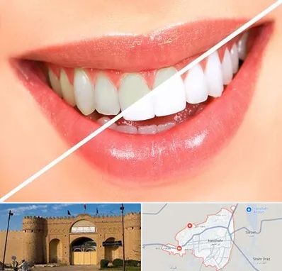 بلیچینگ دندان در ایرانشهر