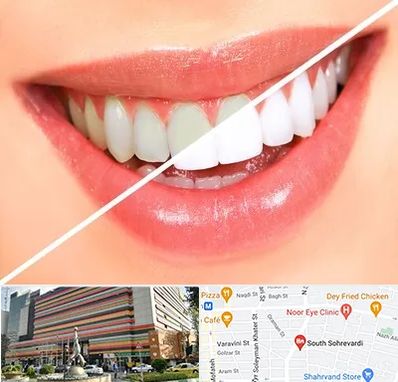 بلیچینگ دندان در سهروردی 