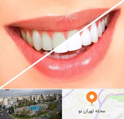 بلیچینگ دندان در تهران نو