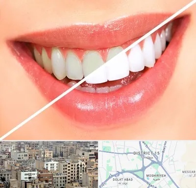 بلیچینگ دندان در جنوب شرق تهران
