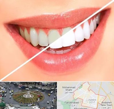 بلیچینگ دندان در فردیس کرج 