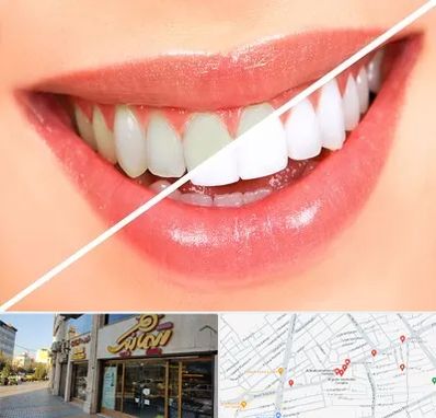 بلیچینگ دندان در عطاران قم