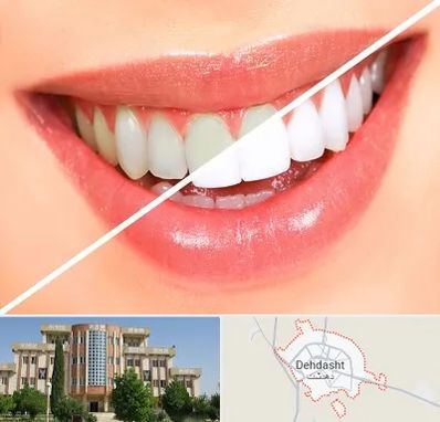 بلیچینگ دندان در دهدشت