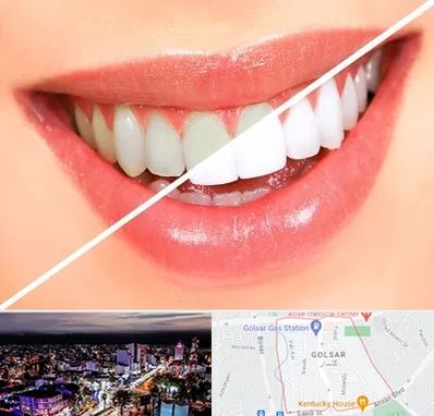 بلیچینگ دندان در گلسار رشت 