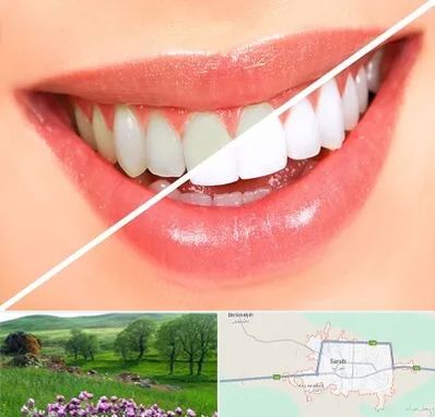 بلیچینگ دندان در سراب