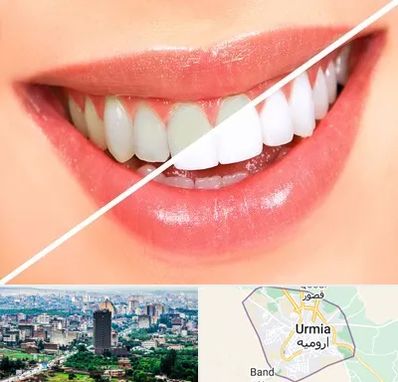بلیچینگ دندان در ارومیه