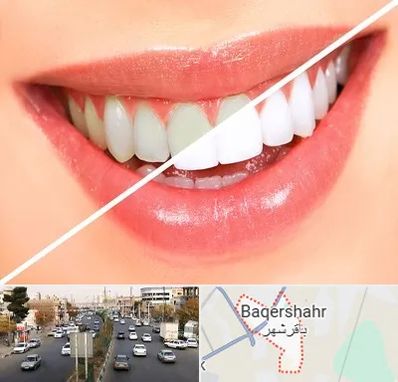 بلیچینگ دندان در باقرشهر