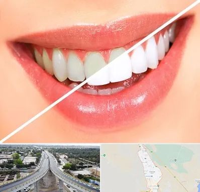 بلیچینگ دندان در اندیمشک