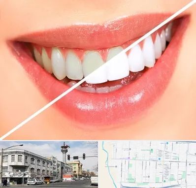 بلیچینگ دندان در 17شهریور