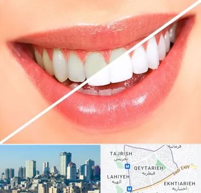 بلیچینگ دندان در قیطریه 