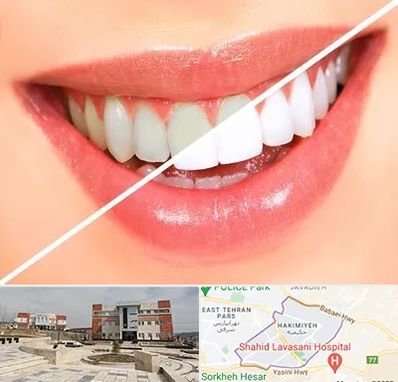 بلیچینگ دندان در حکیمیه 
