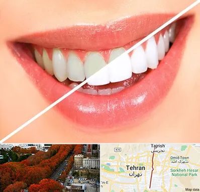 بلیچینگ دندان در ولیعصر 