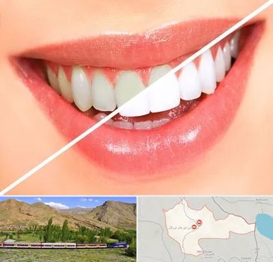 بلیچینگ دندان در خاش