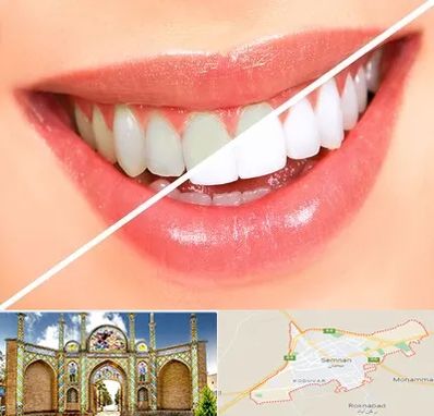 بلیچینگ دندان در سمنان