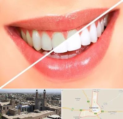 بلیچینگ دندان در سبزوار