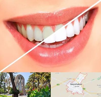 بلیچینگ دندان در نیشابور