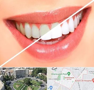 بلیچینگ دندان در جهانشهر کرج 