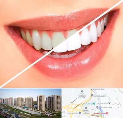 بلیچینگ دندان در المپیک 